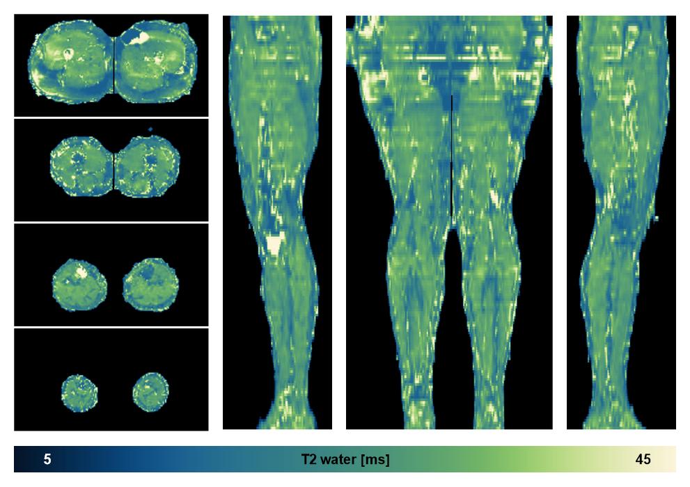 The water only T2 relaxation time of the lower extremity obtained from multi echo spin echo t2 mapping with EPG based reconstruction.